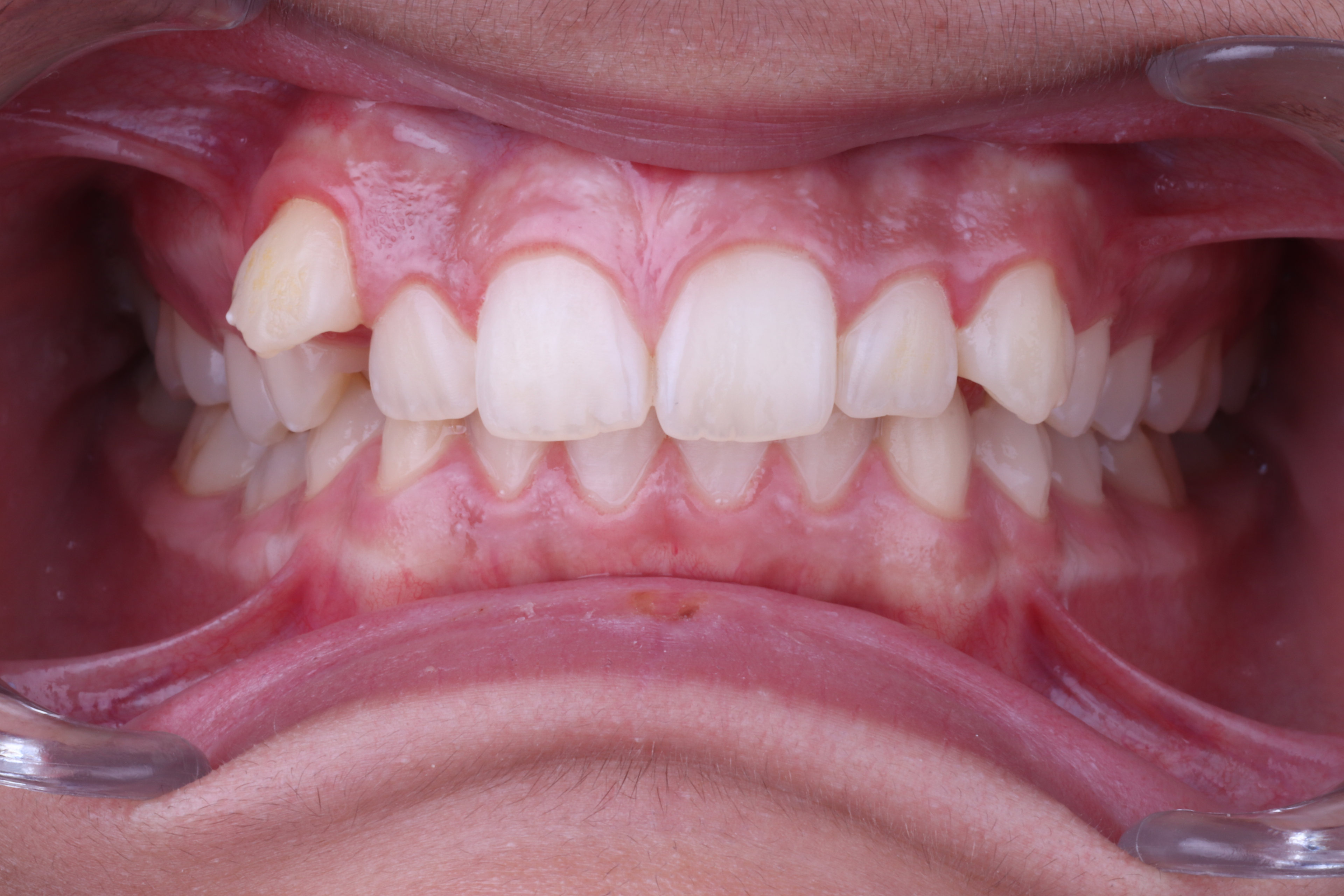 James K. smile transformation after Ceramic Braces