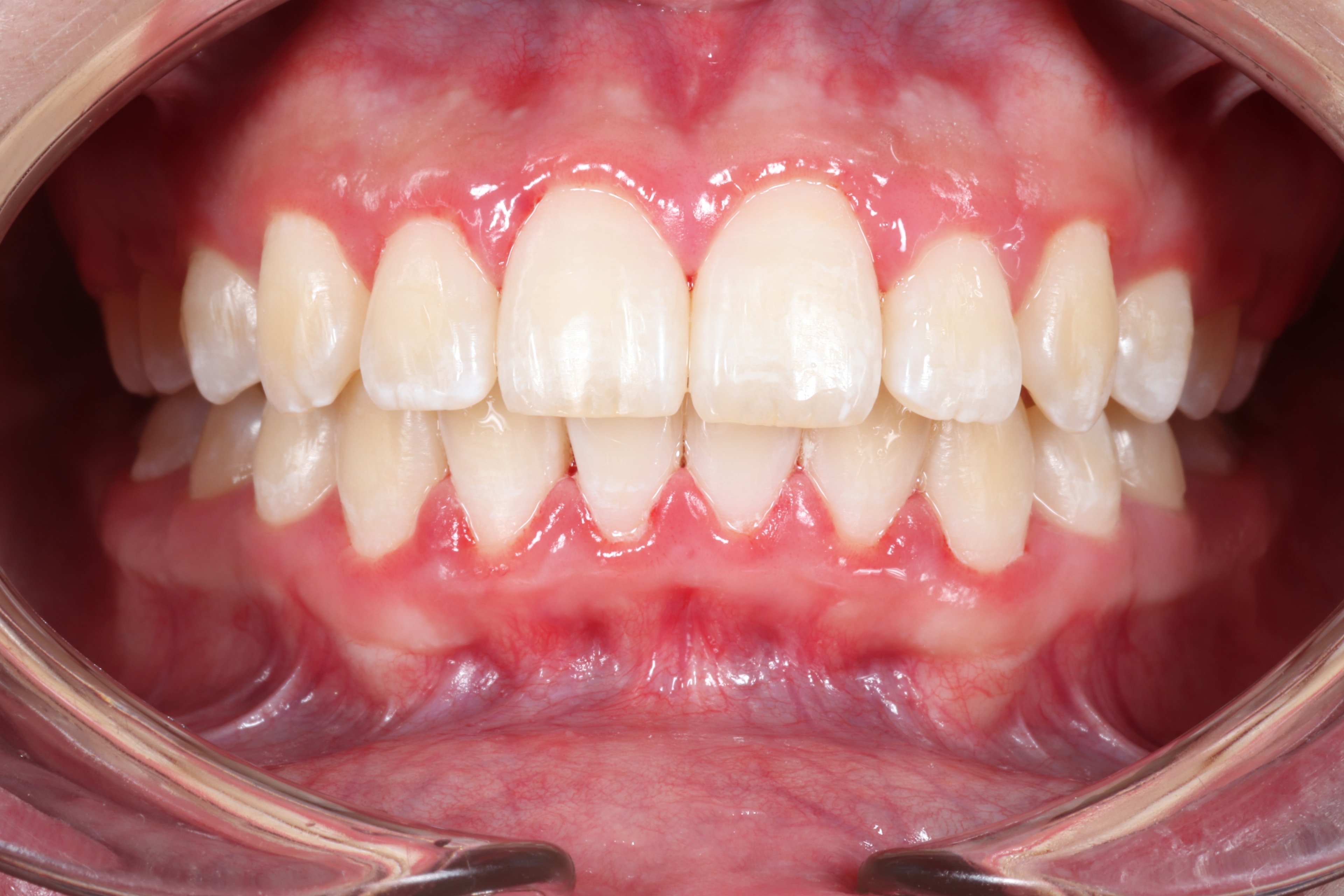 Patient 1 after orthodontic treatment