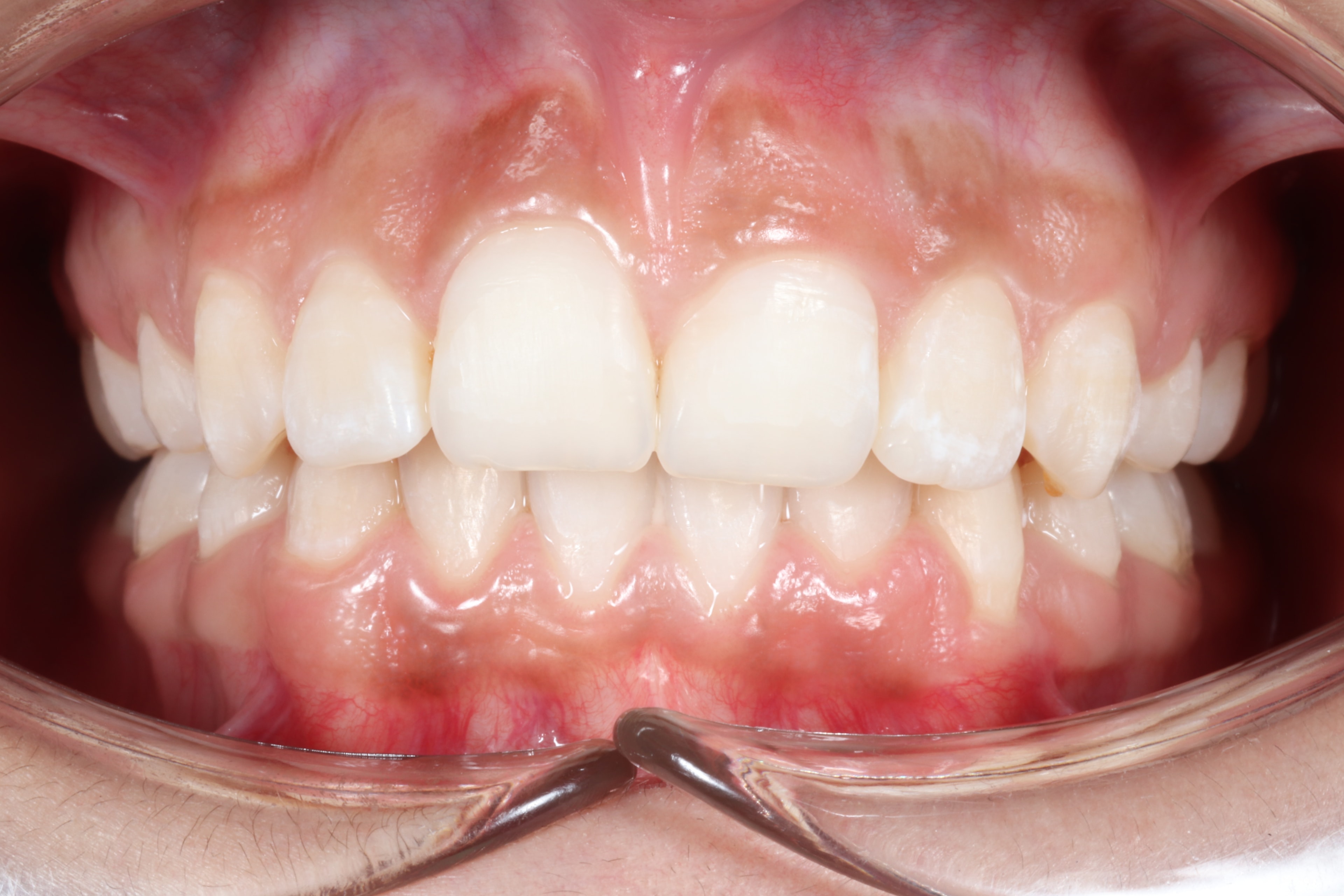 Patient 2 after orthodontic treatment