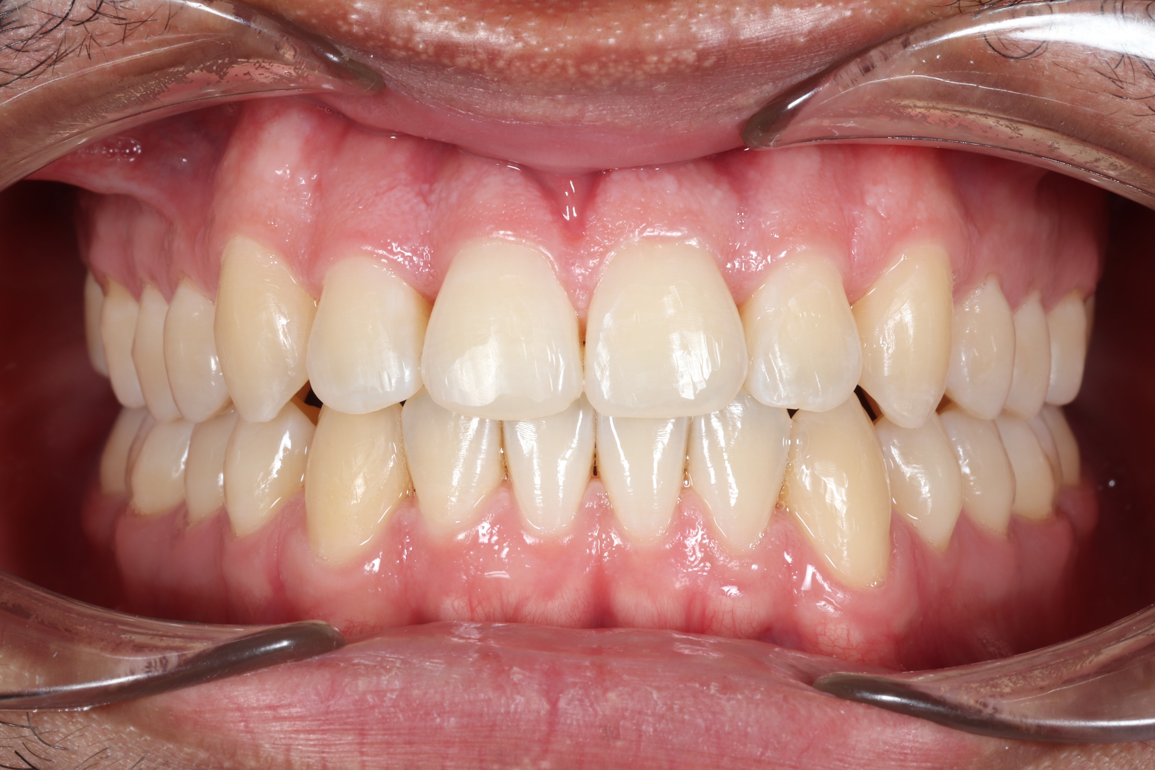 Patient 3 after orthodontic treatment