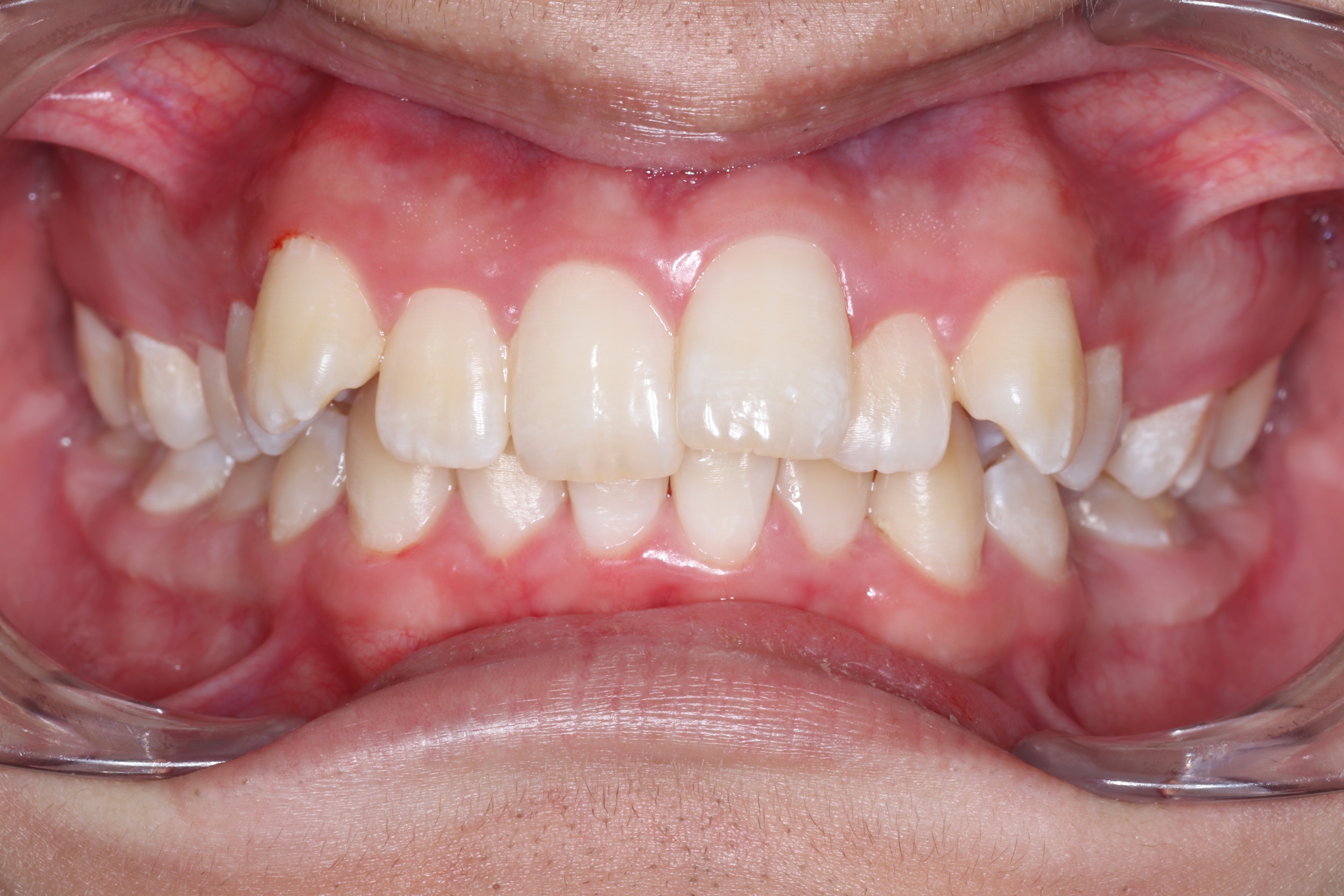 Patient 1 before orthodontic treatment