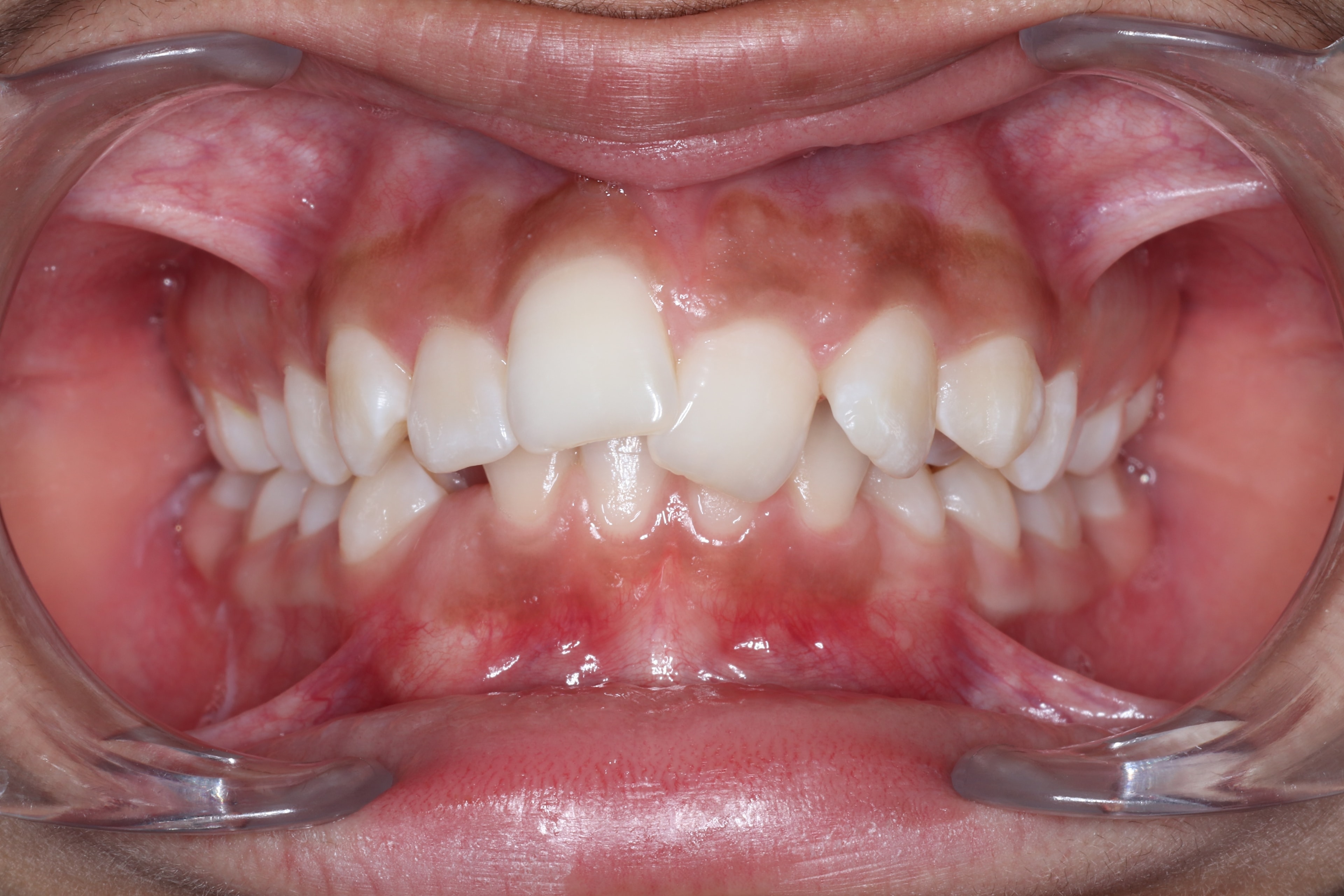 Patient 2 before orthodontic treatment