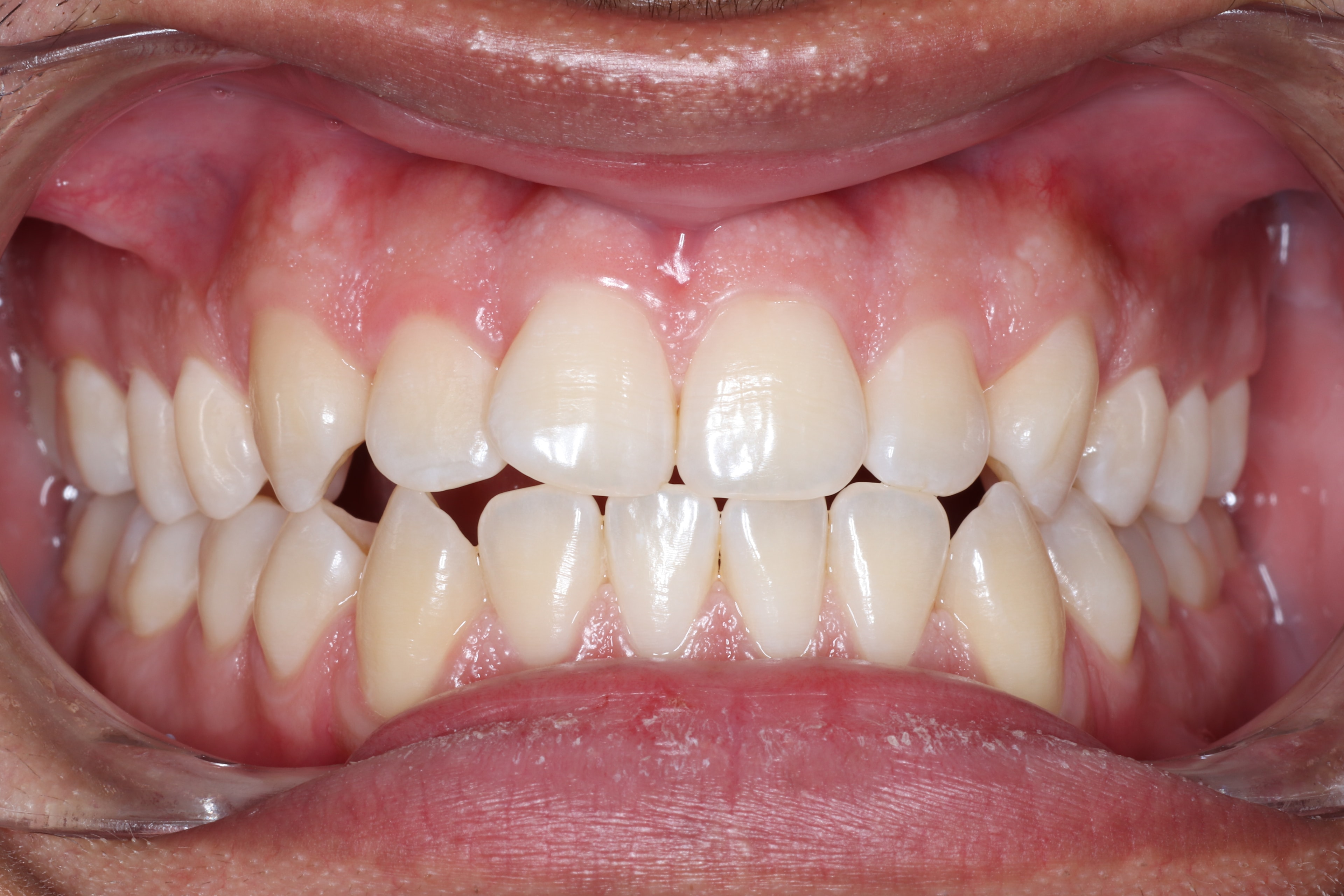Patient 3 before orthodontic treatment
