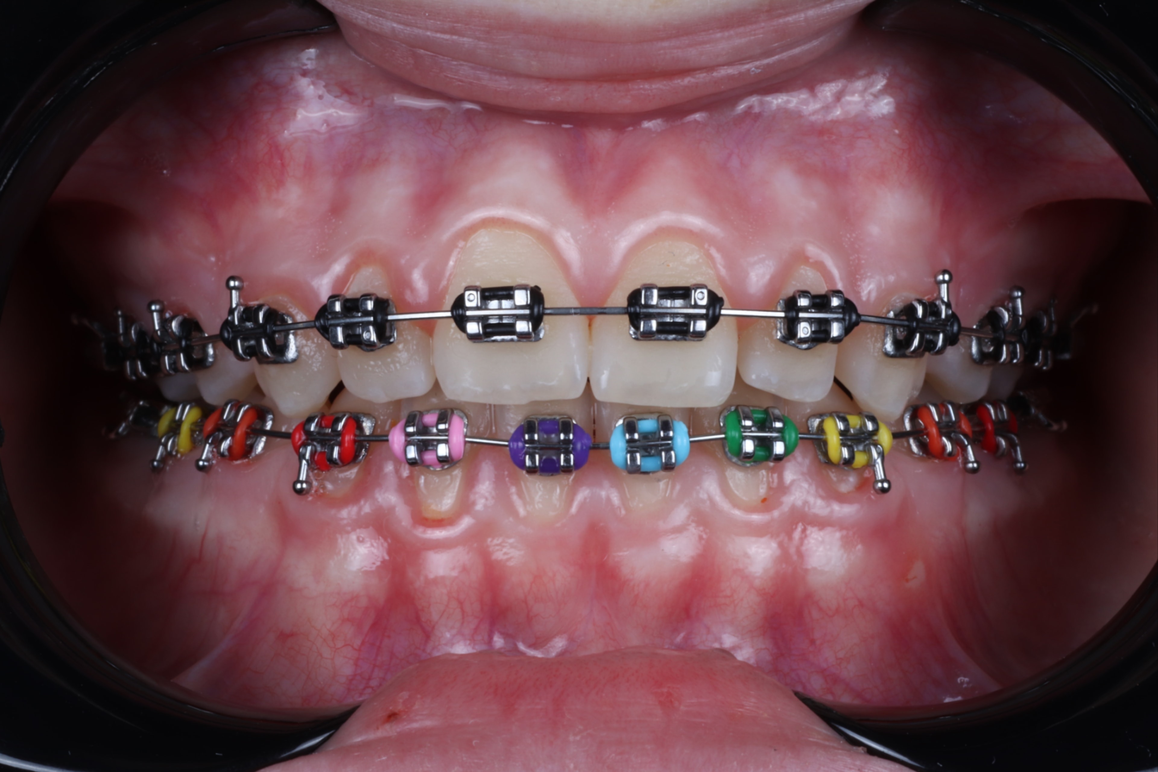 Dental braces treatment