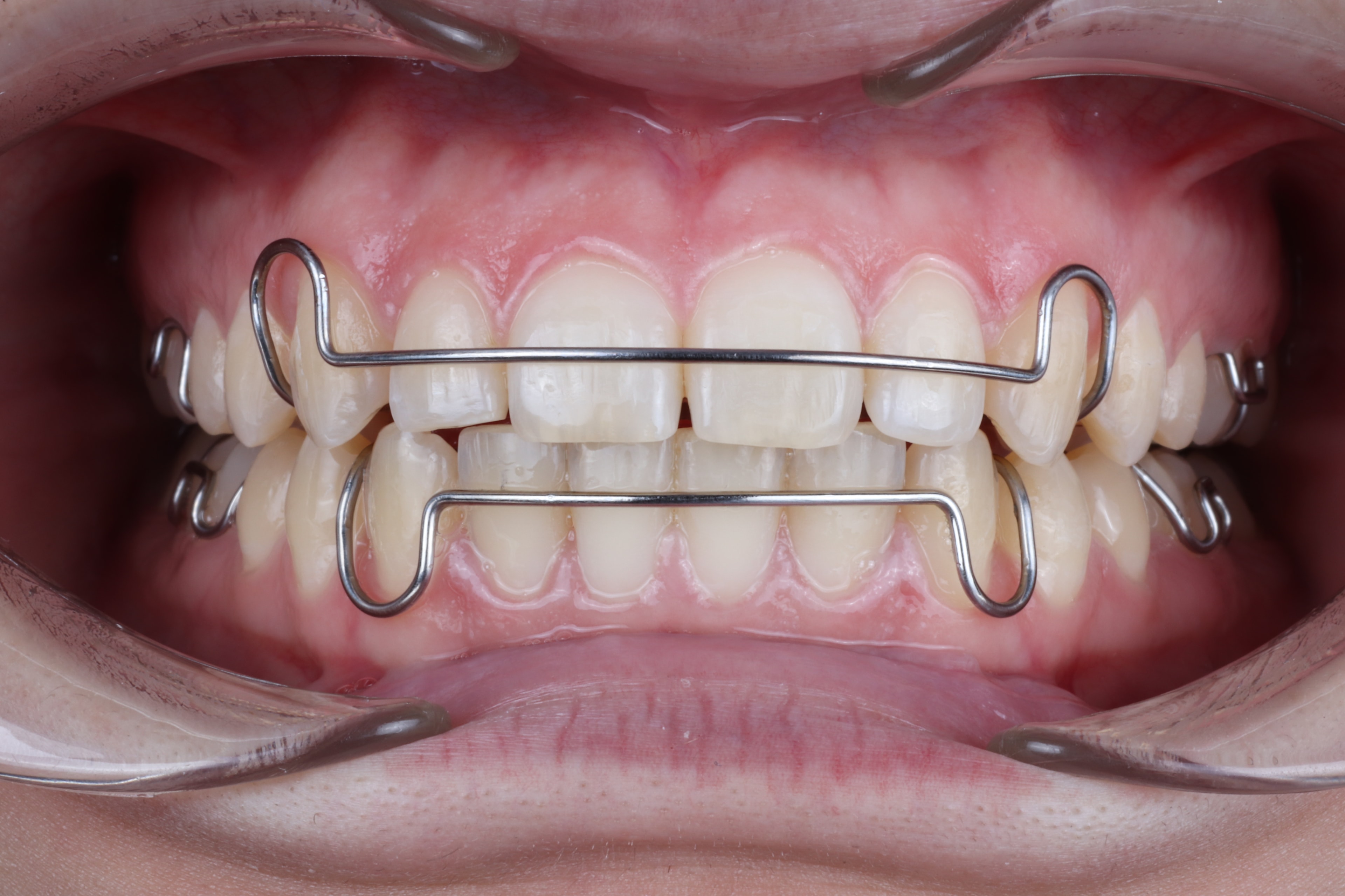 Smile makeover transformation