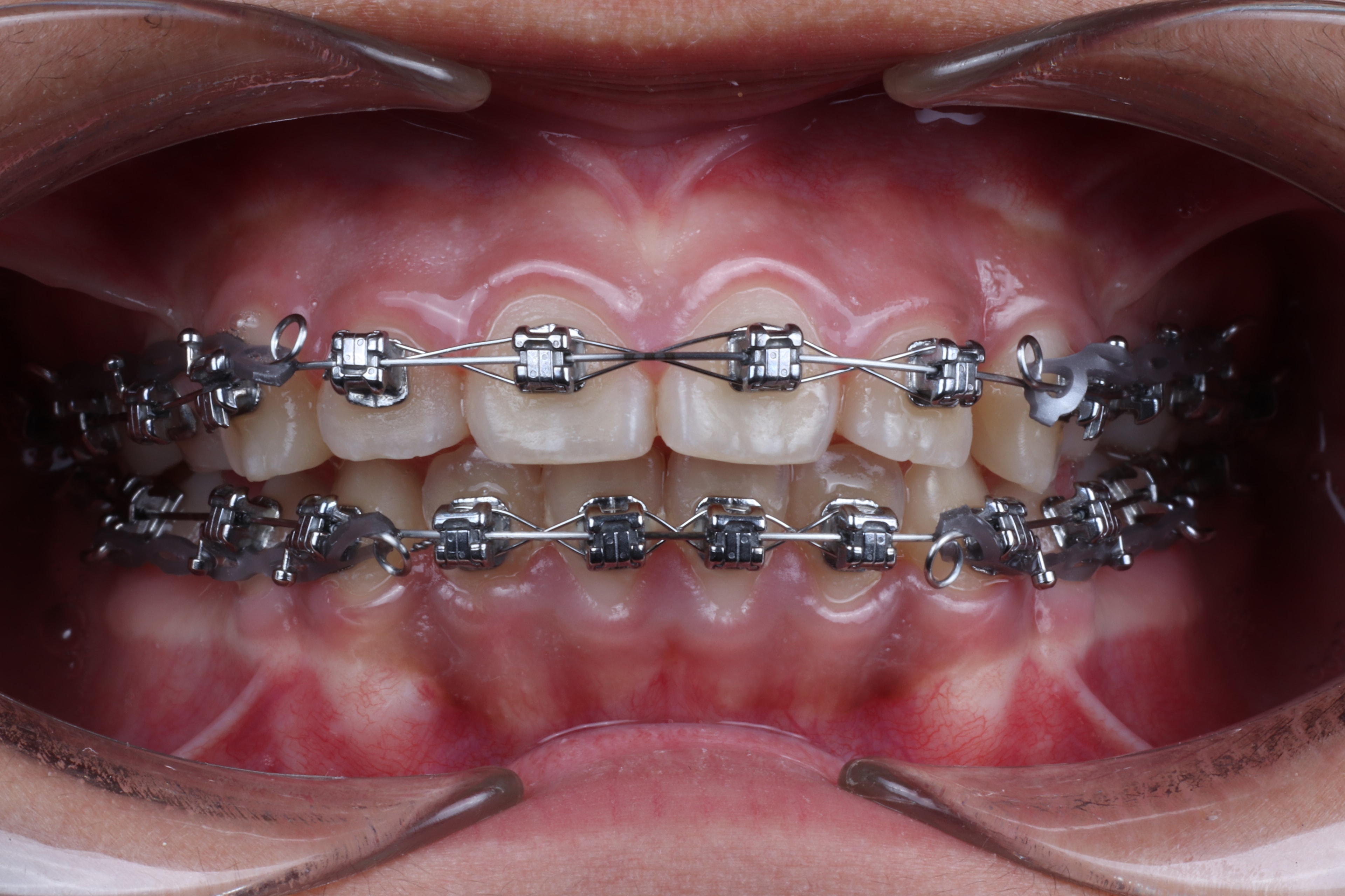 Self-Ligating Metal Braces